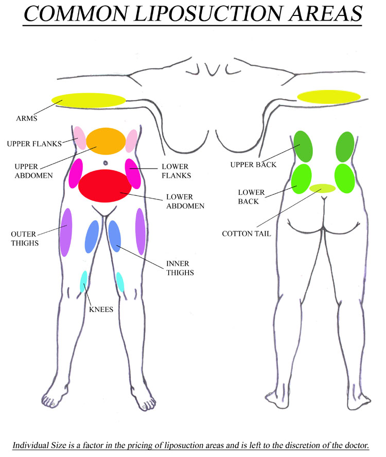 Common Areas of Liposuction